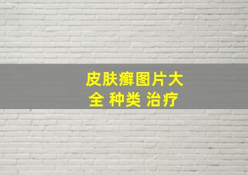 皮肤癣图片大全 种类 治疗